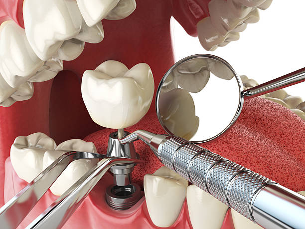 Best Emergency Root Canal Treatment in Portland, TN